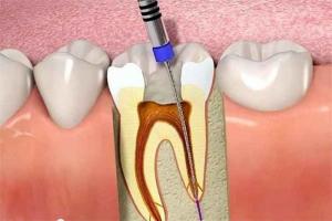 [n] Nha khoa điều trị viêm tủy răng uy tín hiệu quả tại TP. HCM