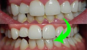 [n] Nha khoa lấy cao răng uy tín hàng đầu tại TP. HCM