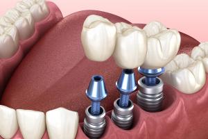 [n] Nha khoa trồng răng Implant cho người trung niên uy tín an toàn tại TP HCM