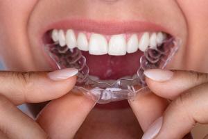 [n] Phòng khám nha khoa niềng răng invisalign uy tín hàng đầu tại Hà Nội