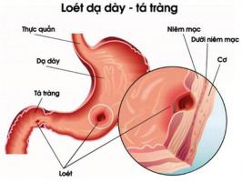 [n] Bệnh viện khám và điều trị viêm loét dạ dày uy tín hiệu quả tại Hà Nội