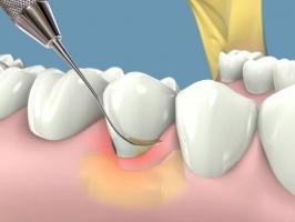 [n] Phòng khám nha khoa lấy cao răng an toàn uy tín tại Hà Nội