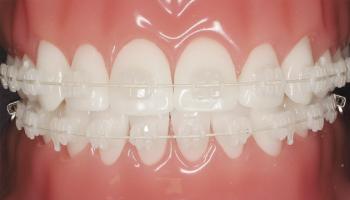 [n] Nha khoa niềng răng mắc cài sứ dây trong uy tín tại TP. HCM