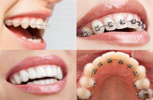 [n] Nha khoa niềng răng trả góp uy tín nhất TP. HCM