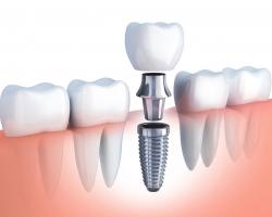 [n] Nha khoa trồng răng implant uy tín tại Quận 5, TP HCM